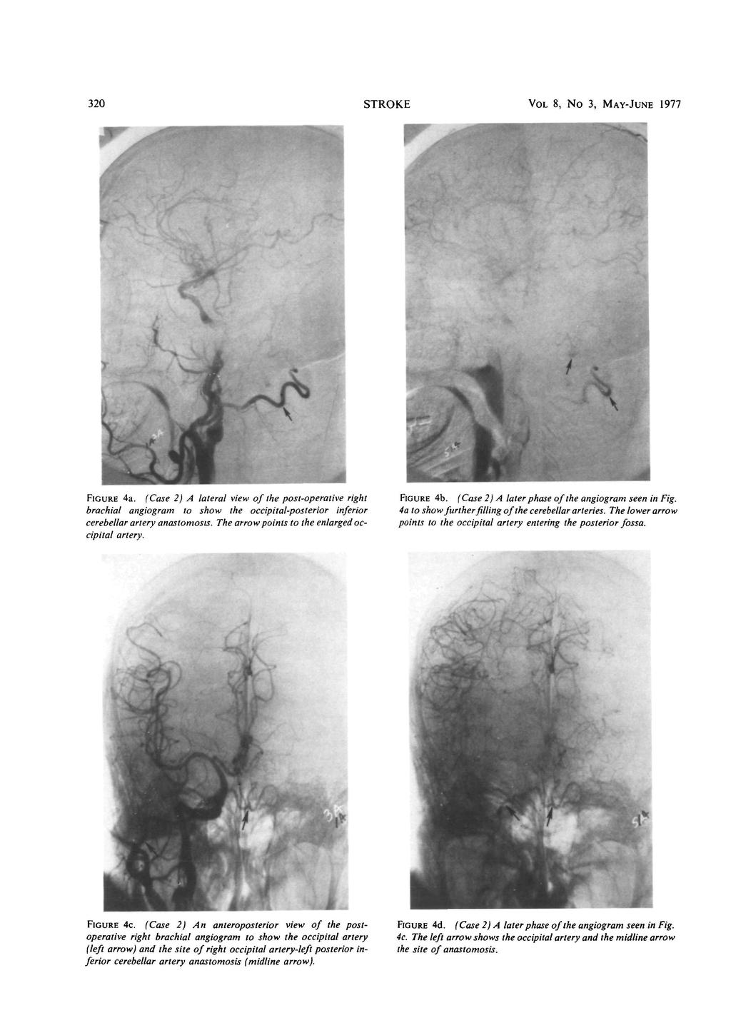 320 STROKE VOL 8, No 3, MAY-JUNE 1977 FIGURE 4a. (Case 2) A lateral view of the post-operative right brachial angiogram to show the occipital-posterior inferior cerebellar artery anastomosis.