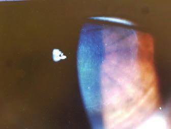 IOP; intra-ocular pressure. GAT; Goldmann applanation tonometry. Figure 1. Post-operative week 1: anterior segment photographs reveal a well-positioned and central intrastromal lamellar graft. pocket.