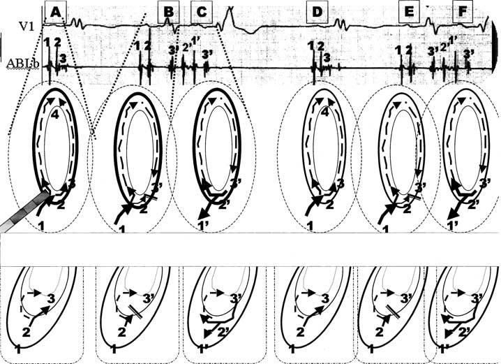 826 Journal of Cardiovascular Electrophysiology Vol. 15, No. 7, July 2004 Figure 2. Firing in the right superior pulmonary vein (RSPV).