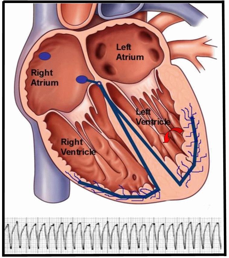 Ventricular Tachycardia (VT) CLINICAL CHARACTERISTICS