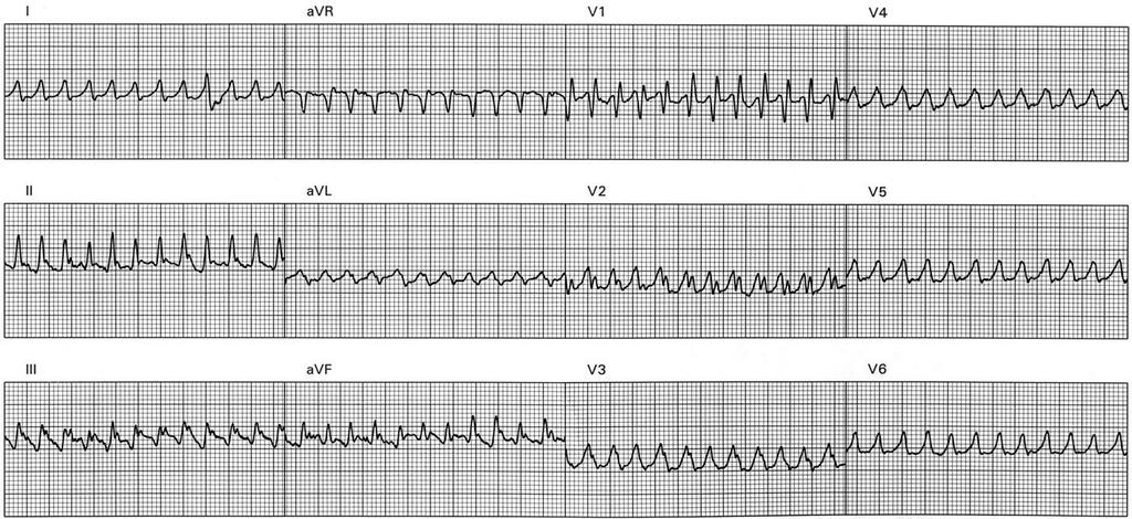 Clinical Diagnosis - ECG - Rapid and irregular heart beats