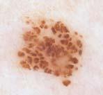 (compound nevus) represent nests of melanocytes at the