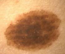 skin carcinoma 74 Benign melanocytic nevus with homogeneous
