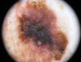 Pigment asymmetrically and negative pigment network in the lower periphery of this melanoma.