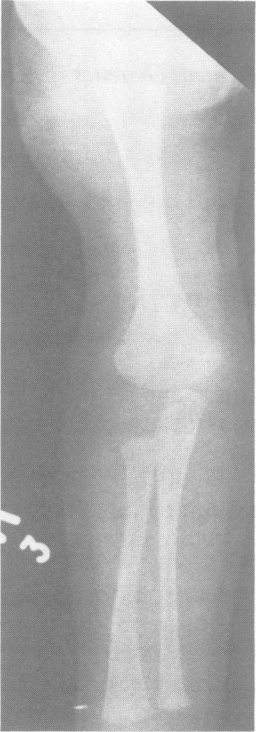 120 FIG 1 Radiograph ofthe right upper limb ofa neonate showing the flared humeral metaphysis. FIG 2 Radiograph ofthe rightfemur ofa neonate showing a dumb bell configuration with broad metaphyses.