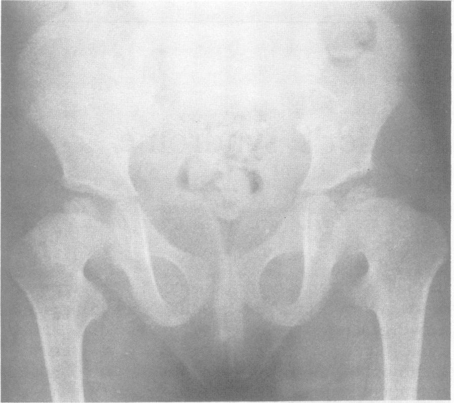 .: FIG 3 Pelvic x ray ofan older child showing short, wide femoral necks, prominent lesser trochanters, and small flattened capitalfemoral epiphyses with irregular ossification.