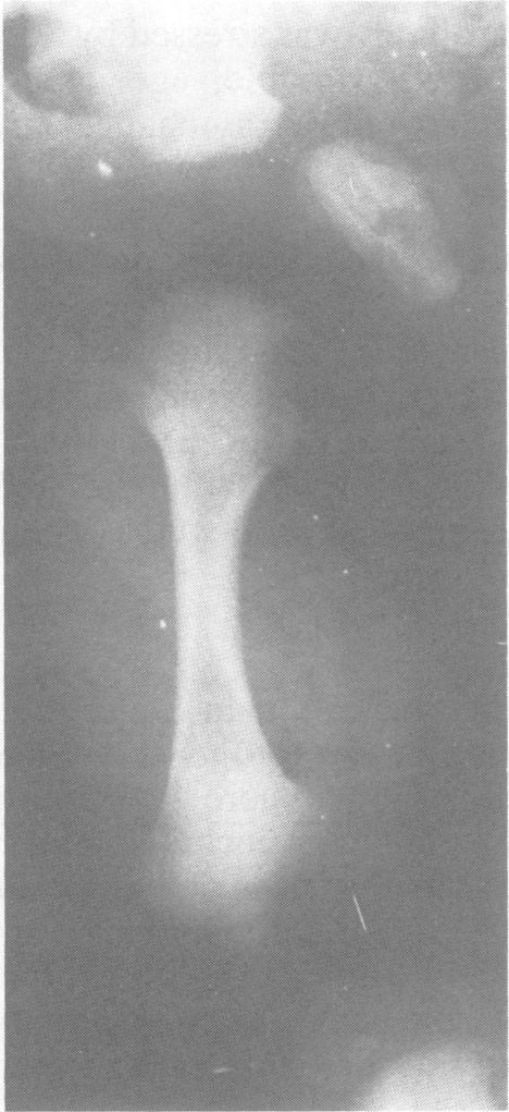 X ray findings show secondary degeneration of the articular surfaces with irregularity and widening of the joint spaces and fiattening and irregularity of the vertebral bodies.