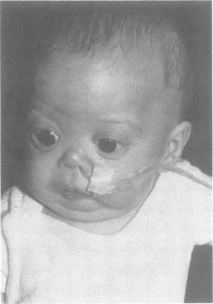 122 FIG 7 Facialfeatures ofan infant aged four months. The flat nasal bridge and small nose are marked. Note the presence ofepicanthic folds.