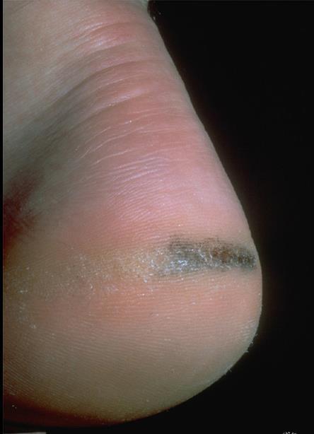 The most likely diagnosis is: A. Acral melanoma B. Dysplastic nevus C.