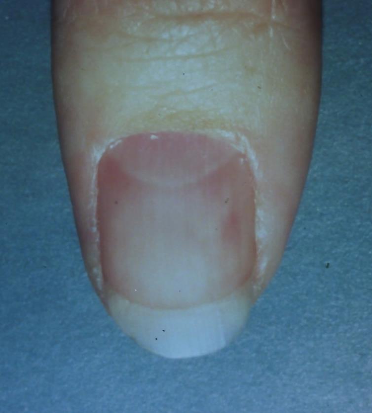 Distractors Glomus tumor Painful distal or