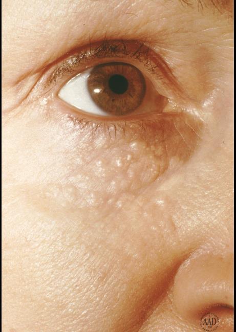 This developmentally normal patient presents to you for cosmetic removal of these lesions.