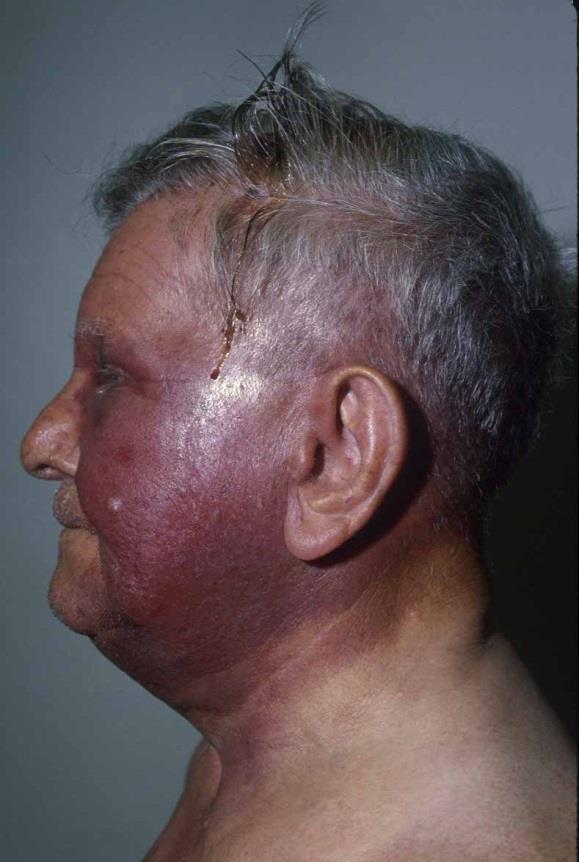 Angiosarcoma: 50% occur on head and