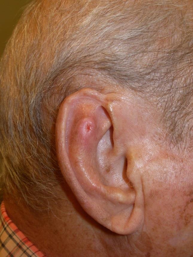 The most likely diagnosis is: A. Amelanotic melanoma B. Basal cell cancer C.