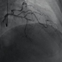 PCI : up to 50% diffuse stenosis in proximal segment. Mid segment is occluded, forward blood flow at TIMI grade 0.