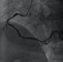 stenosis in mid segment, forward blood flow at TIMI grade 3 Angiography: Trans-radial access on right arm with 6F artery sheath.