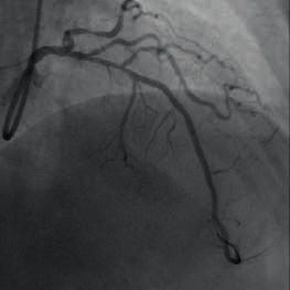 After consulting with other experts, physician planned to do a PCI in the PCI: Balloon dilatation (12 atm) in the mid-distal segment of the artery. Distal end: Tivoli 2.5* 35 mm stent implantation.