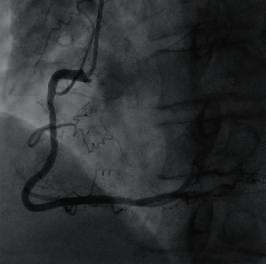 PCI : proximal segment occluded, forward blood flow at TIMI grade 0.
