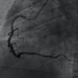 D1 occlusion, forward blood flow at TIMI grade 0 LCX: 20% diffuse stenosis in proximal mid segment, forward blood flow at TIMI grade 3 RCA: Could