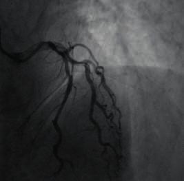 proximal segment, forward blood flow at TIMI grade 3 RCA: the vessel lumen was not smooth. Could see shadow of plaque.