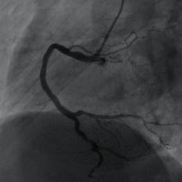 Forward blood flow at TIMI grade 3 Angiography: Trans-radial access on right arm with 6F artery sheath.