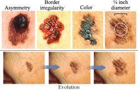TYPES OF SKIN CANCER MELANOMA Look for