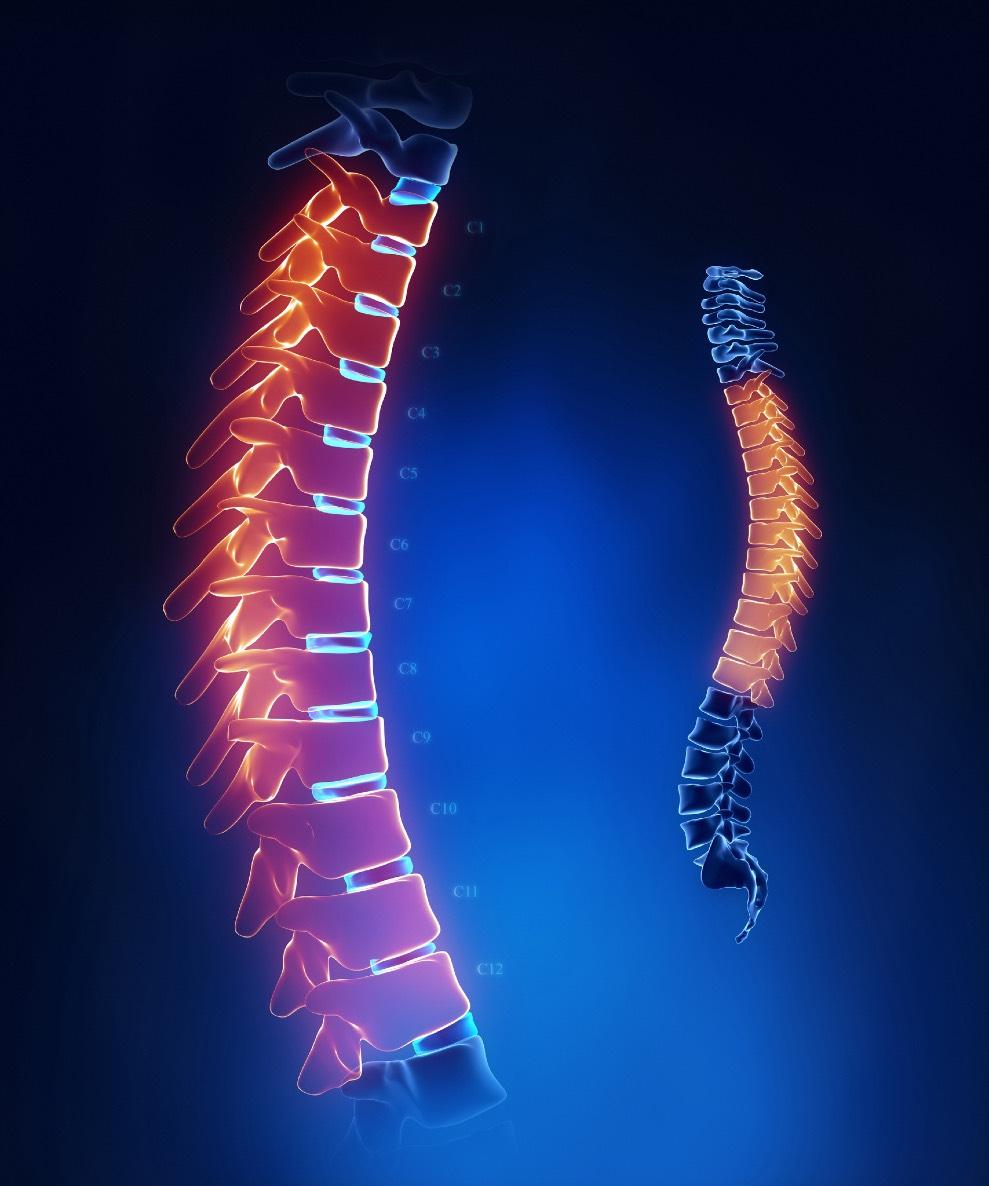 TURN BACK THE CLOCK ON YOUR SPINE FBSS is certainly a concern. However, there are both ways to avoid it and solutions for living better if you are already suffering from back pain. Dr.