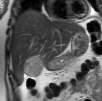Hepatology 2008 Inflammatory Hepatic Adenoma: MRI