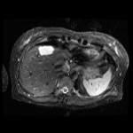 Hepatic Cysts Very common (14%), >40 yo Develomental: remants of blind ending biliary ducts