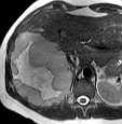 Infection/abscess Cholangiocarcinoma Metastasis Atypical hemangioma Biliary Cystadenoma