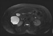 Hamartoma with ovarian stroma (females)-better prognosis without