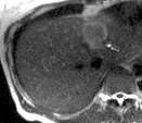 high SI on Areas with no enhancement Neuroendocrine, sarcomas,