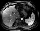 Metastasis Atypical hemangioma Biliary Cystadenoma Biliary