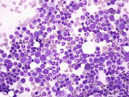 N=1971 Leukemia at diagnosis Recovering bone marrow Methods: Flow cytometry: aberrant immunophenotypes (~0.