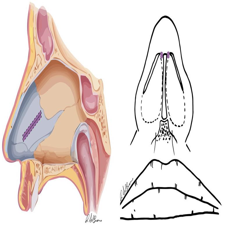 Page 4 of 9 Figure 4: Swinging door manoeuvre: left, the caudal septum excess is removed allowing the septum to swing to the midline; right, the position may be secured with an absorbable suture
