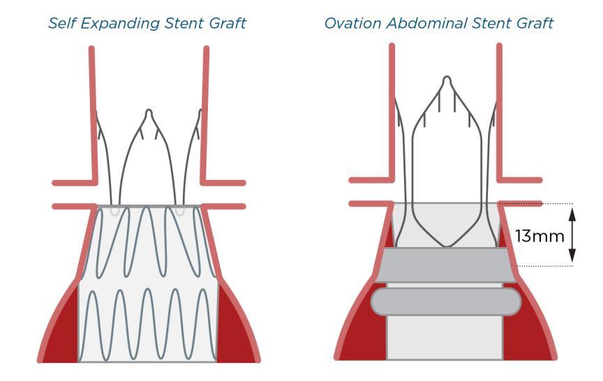 Ovation Custom Seals to Each Patient Anatomy Reverse Taper Neck