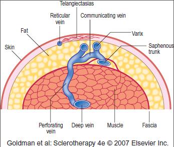 Where does Visually Guided Sclerotherapy fit in?