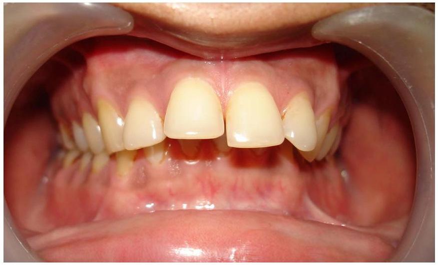 Clinical Report A moderately built, 27 year old male patient complained of mal-aligned teeth. He wanted a smile makeover urgently, as he was getting married the next week.