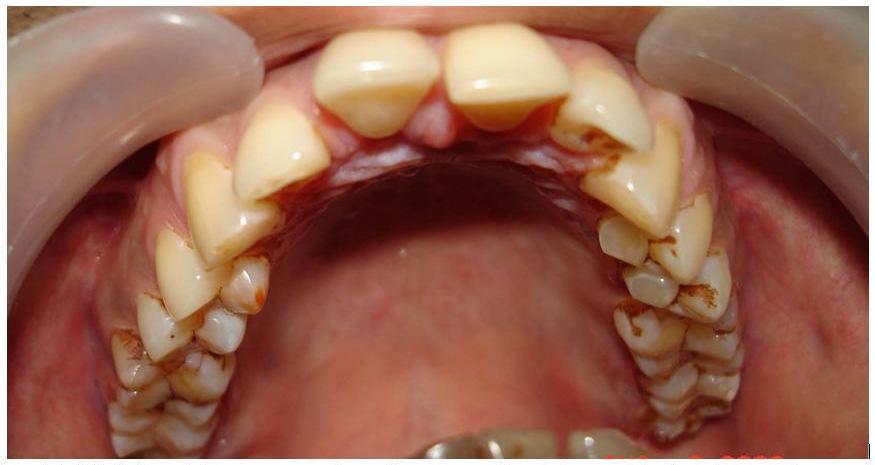 He had a deep bite, with his mandiular anterior teeth touching the palatal mucosa. The overjet was 6mm.