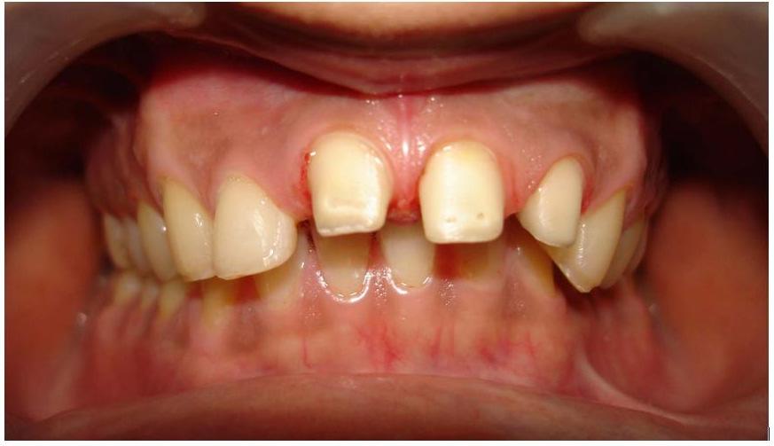 (Table/Fig 1). Pre-operative photograph of the teeth-frontal view (Table/Fig 2).