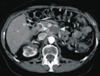 safe therapy for hepatocellular carcinoma adjacent to major hepatic veins.