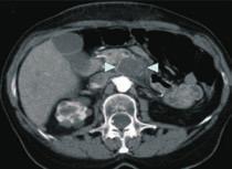 CT image shows a large tumor adjacent major hepatic veins (b) Enhanced MR images shows no enhancement in treated region and no