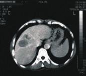 (a) MRI before HIFU shows a 2.4-cm lesion (arrowheads).