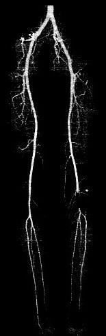 Perpendicular to median arterial centerline MR Angiography Traditional: Time of flights