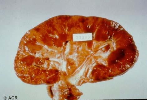 Scleroderma Kidney