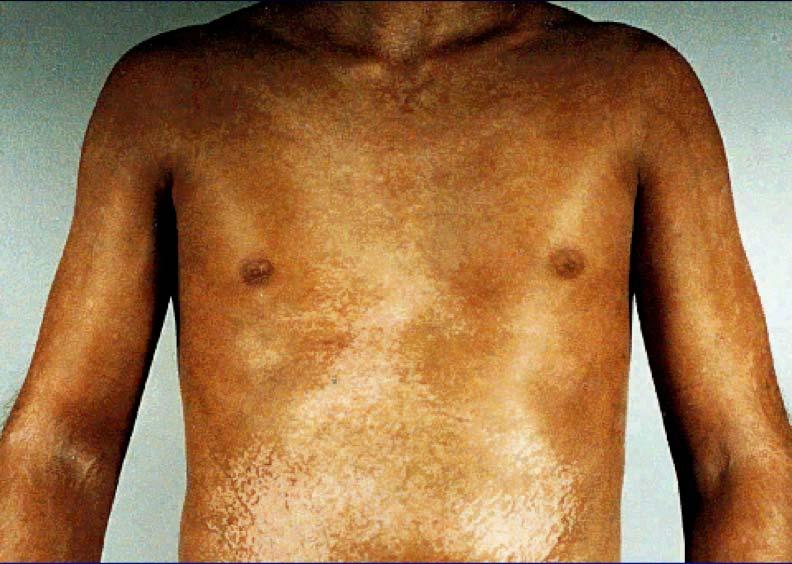 Diffuse Scleroderma