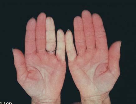 Raynaud s Phenomenon Early manifestation of disease in >97% of scleroderma patients, preceding sclerodactyly by months to years Vasospasm of the digital