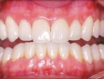An occlusal index is constructed registering the occlusal and incisal edges of the upper teeth.