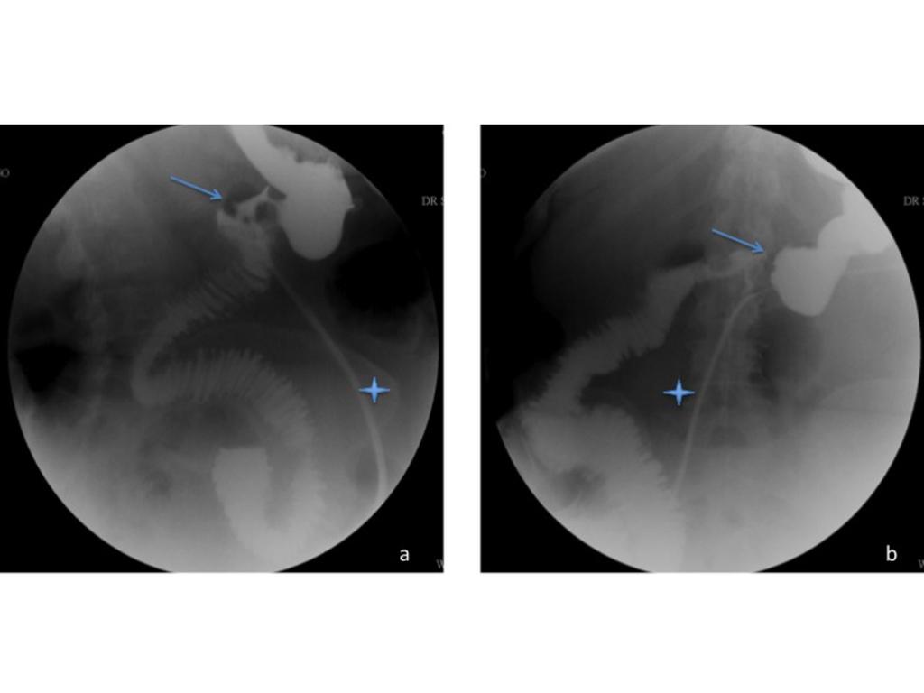 Fig. 6: Biliopancreatic diversion and duodenal switch with duodenal-ileal