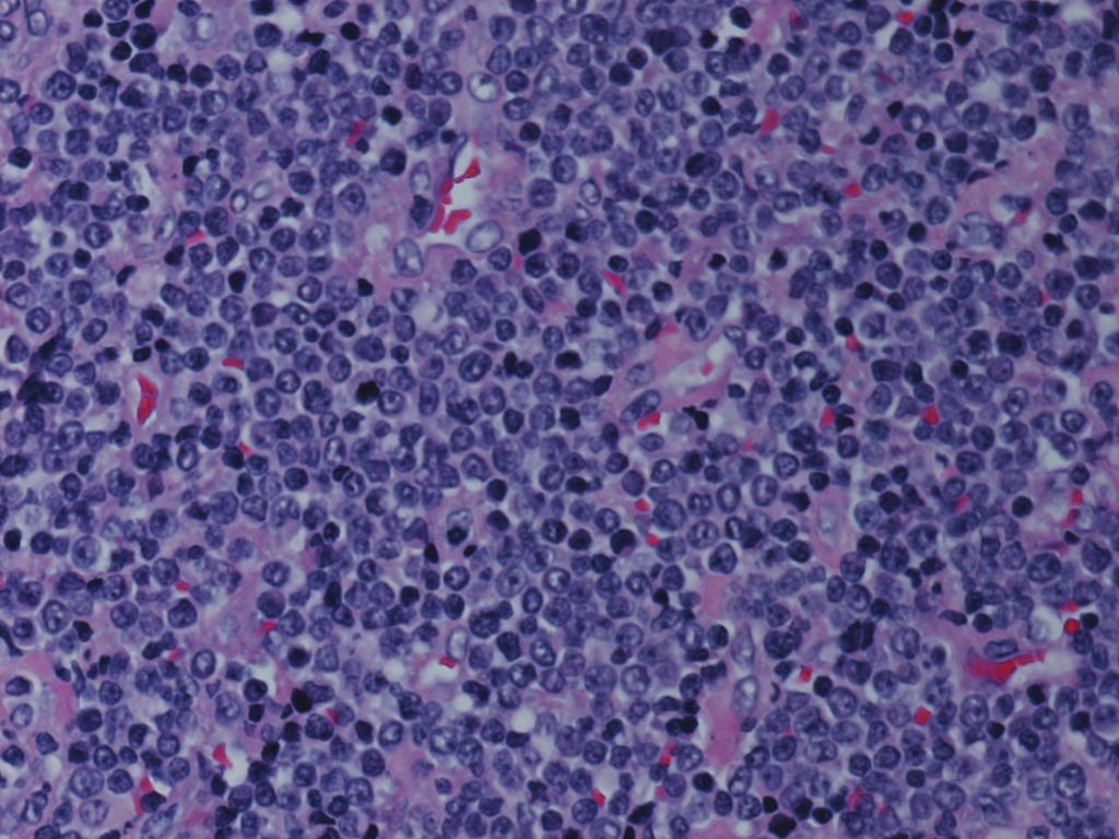 2 Case Reports in Hematology (a) (b) (c) Figure 1: Supraclavicular lymph node biopsy ((a) H&E, 40x; (b) IHC stain for CD3, 10x; (c) IHC stain for CD99, 10x).
