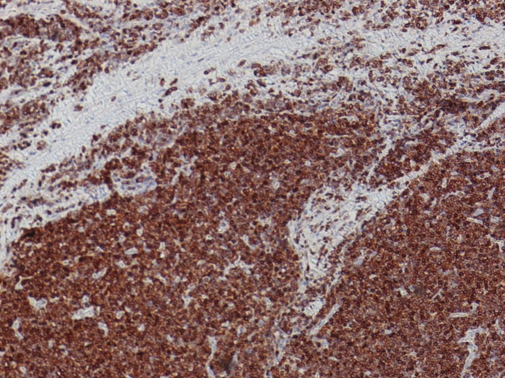 The lymph node biopsy showed malignant lymphoma, lymphoblastic (high grade). The immunophenotype was positive for CD2, CD3, CD5, CD7, TdT, and HLA-DR.